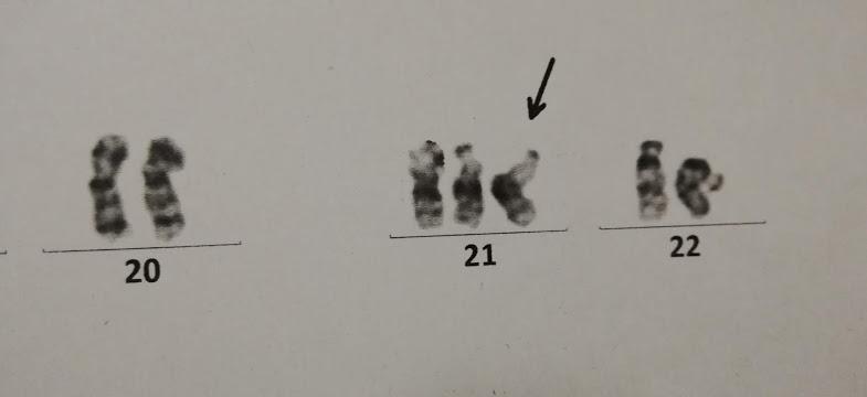 21番目染色体が3本